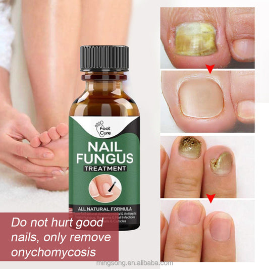 SurtiWala.pk™ - Nail Fungi Treatment Serum
