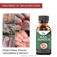 SurtiWala.pk™ - Nail Fungi Treatment Serum