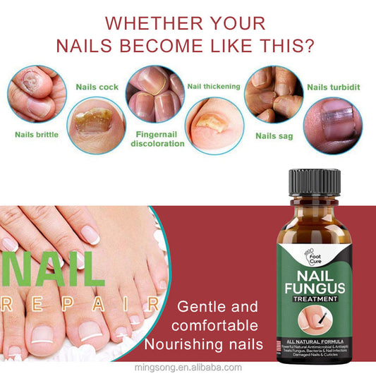 SurtiWala.pk™ - Nail Fungi Treatment Serum